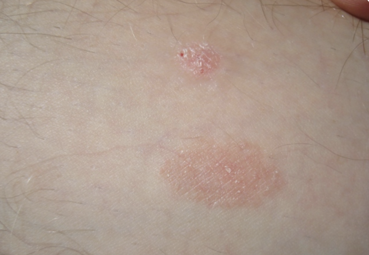 Psoriasis Causes by Parasites